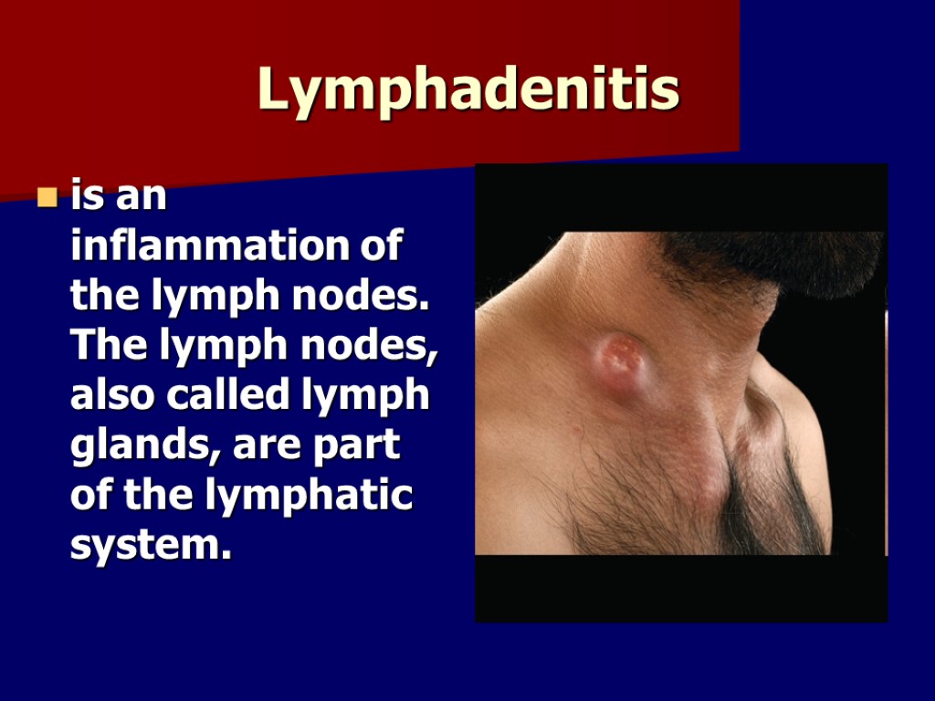 Lymphadenitis is an inflammation of the lymph nodes. The lymph nodes, also called lymph